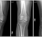 Alternative Options For Luxating Patella