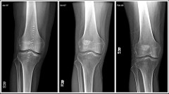 Alternative Options For Luxating Patella