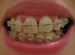 Braces and Chiropractic
